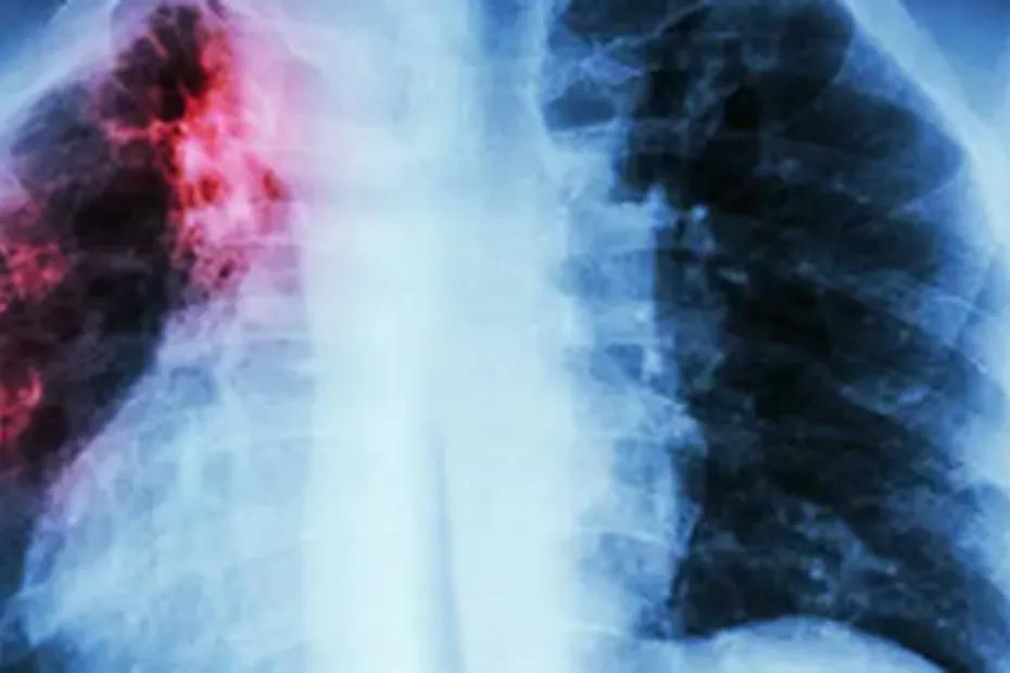 Самарский специалист рассказала, как защититься от туберкулёза