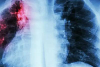 Самарский специалист рассказала, как защититься от туберкулёза