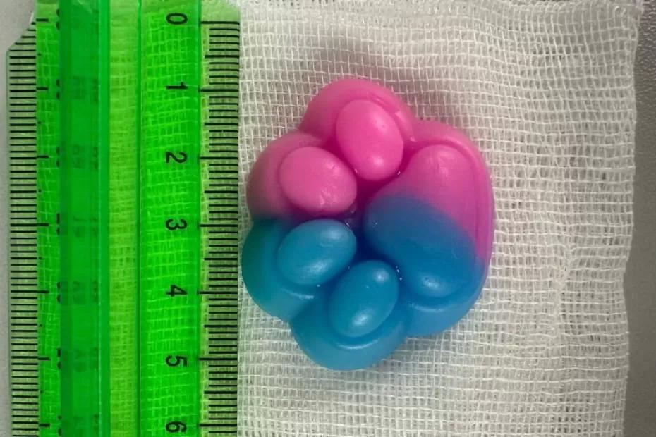 Врачи бьют тревогу из-за коварной игрушки: проглоченная таба-лапка резко увеличилась в желудке ребенка