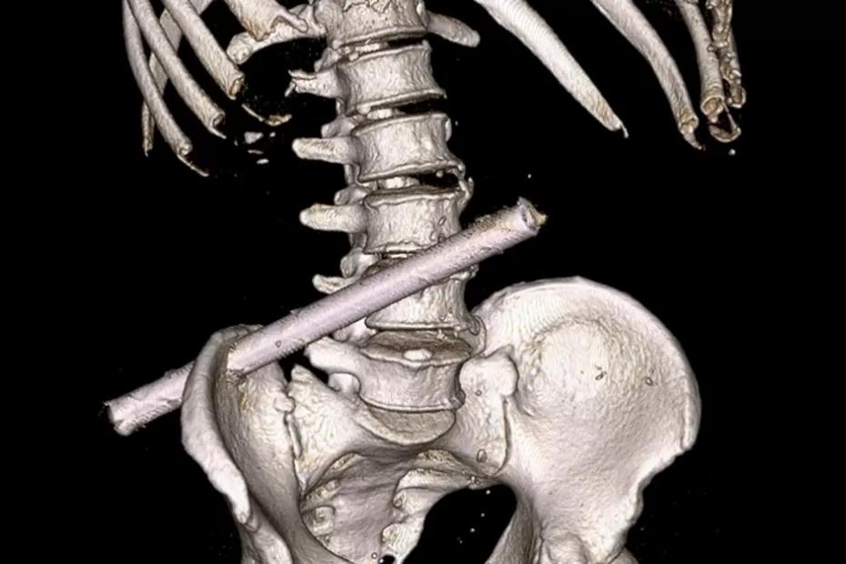 Пьяный мужчина три дня ходил с 25-сантиметровой железной трубой в теле