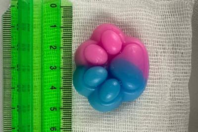 Врачи бьют тревогу из-за коварной игрушки: проглоченная таба-лапка резко увеличилась в желудке ребенка