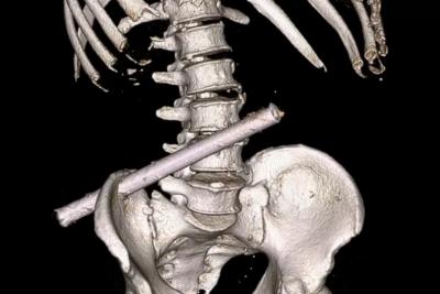 Пьяный мужчина три дня ходил с 25-сантиметровой железной трубой в теле